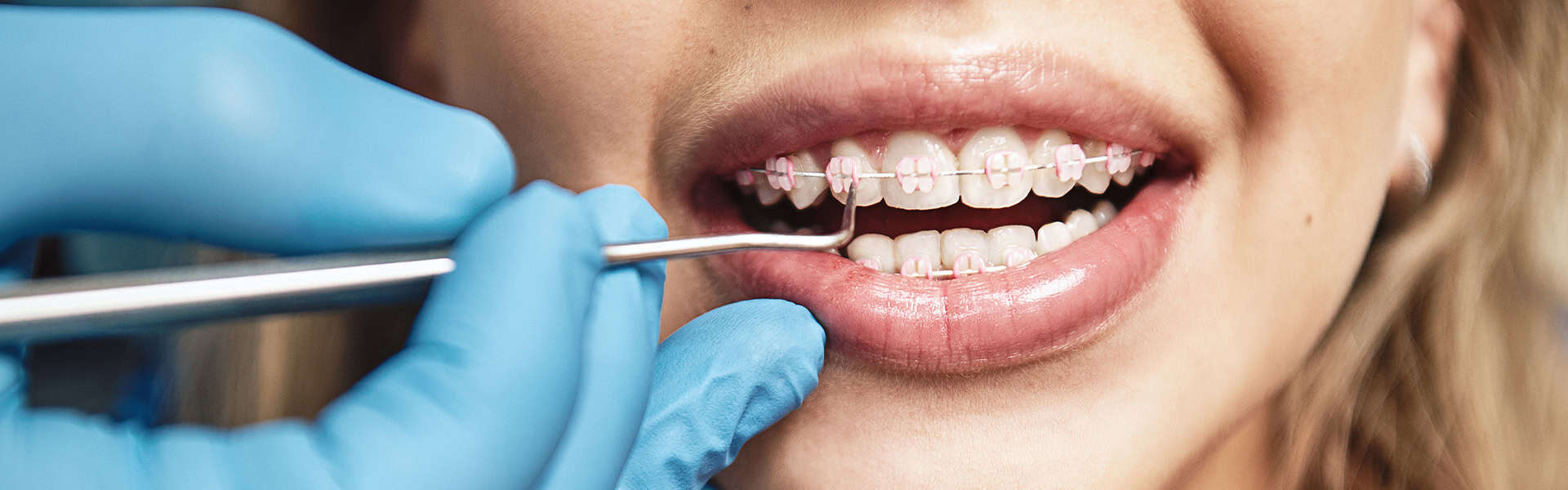 Orthodontist Adjusting Pink Braces On Patient