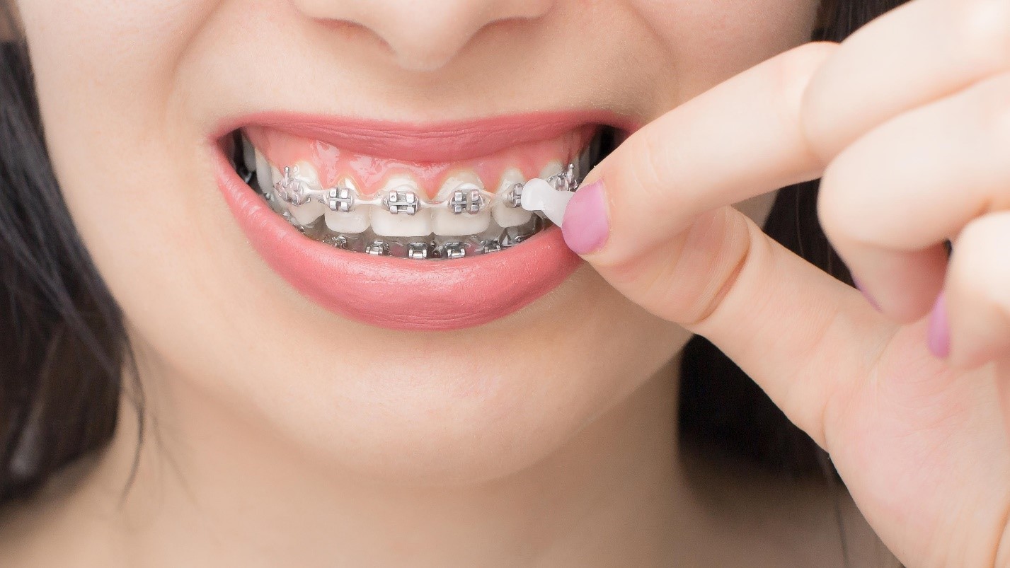 Can You Eat With Orthodontic Wax? Dos and Don'ts for Braces Wearers, image size:1427x803
